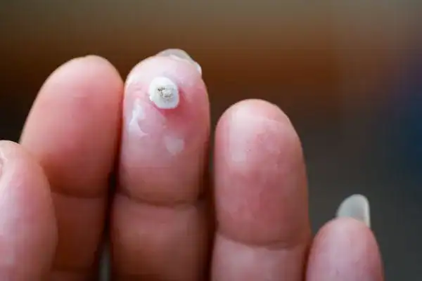 Image of white wart before cryopen treatment Sandbach