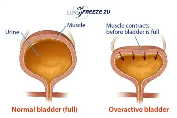 diagram of overactive bladder treatment Sandbach