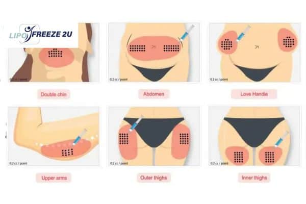Benefits of Choosing Aqualyx for Fat Reduction Sandbach
