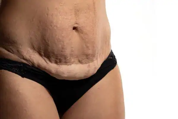 loose skin after weight loss injections Sandbach