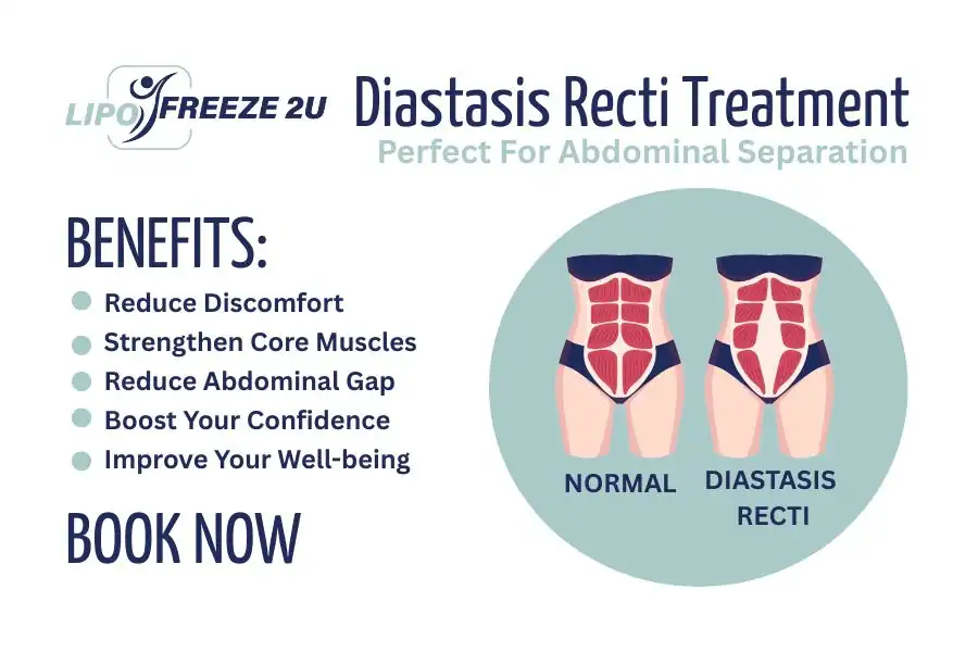 How Long Will It Take to See Improvements in Diastasis Recti Sandbach