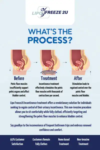 Diagram of how incontinence treatment Sandbach works.