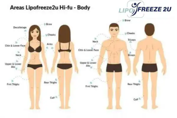 image of areas of the body and HIFU prices Sandbach