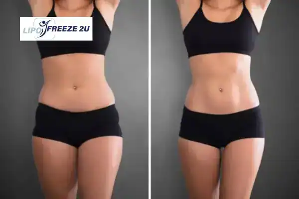 How Can LIPO FREEZE 2U Support Your Post-Pregnancy Body Recovery Sandbach?