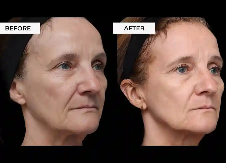 How Many RF Microneedling Sessions Will You Need to See a Difference Sandbach?