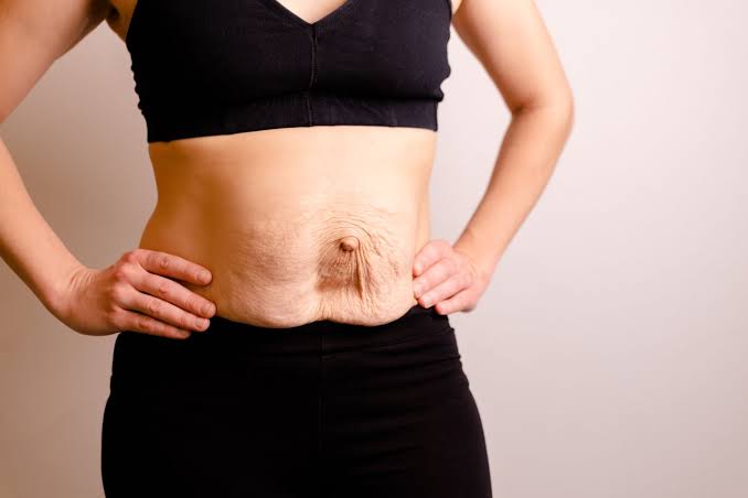 Is Surgery Really the Only Way to Repair Diastasis Recti Sandbach?